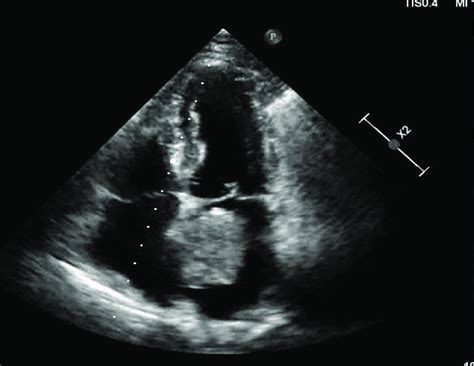 left atrial mass echo.